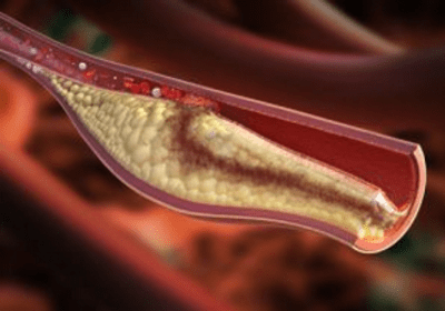 high-cholesterol-can-be-improved-by-lactic-acid-bacteria