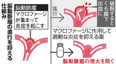 cerebral-aneurysm-will-be-suppressed-with-medicine